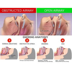 DreamHero Horkolás Elleni Fogvédő – Állkapocshelyzet - állító Eszköz a Nyugodt Alvásért - BShopy