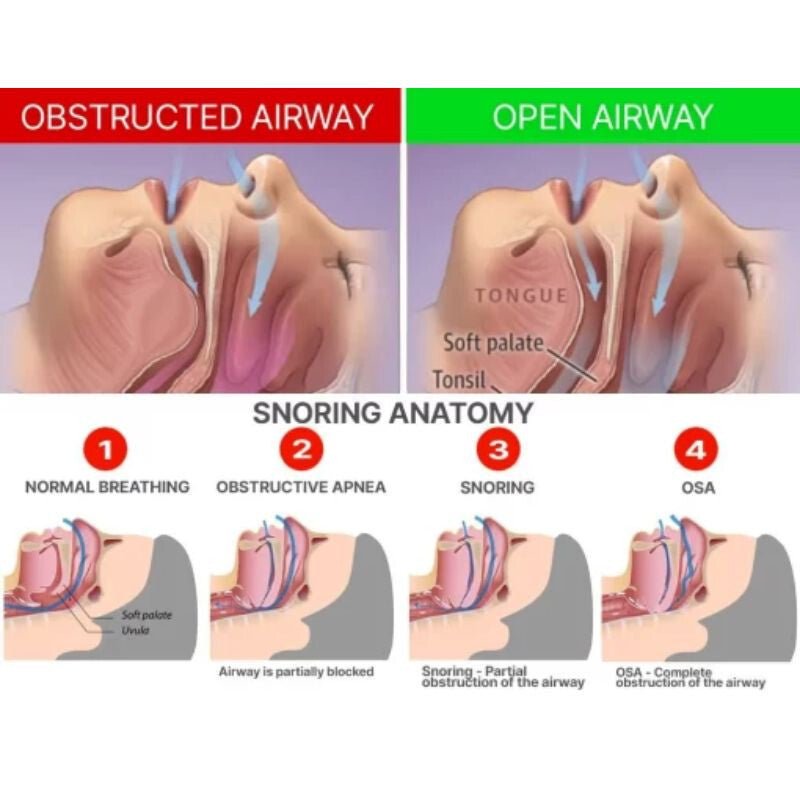 DreamHero Horkolás Elleni Fogvédő – Állkapocshelyzet - állító Eszköz a Nyugodt Alvásért - BShopy